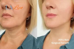 hi-fu for wrinkles Cumbernauld before and after results