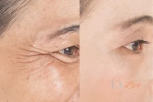 Before and after results of woman - HI-fu wrinkles reduction treatment Cumbernauld