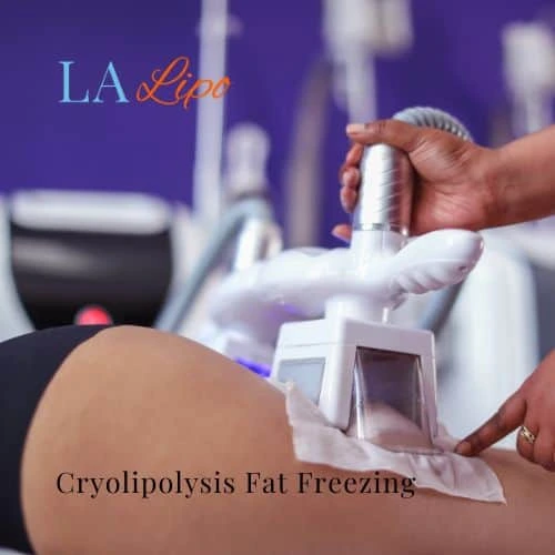 fat freezing - Cryolipolysis Cumbernauld