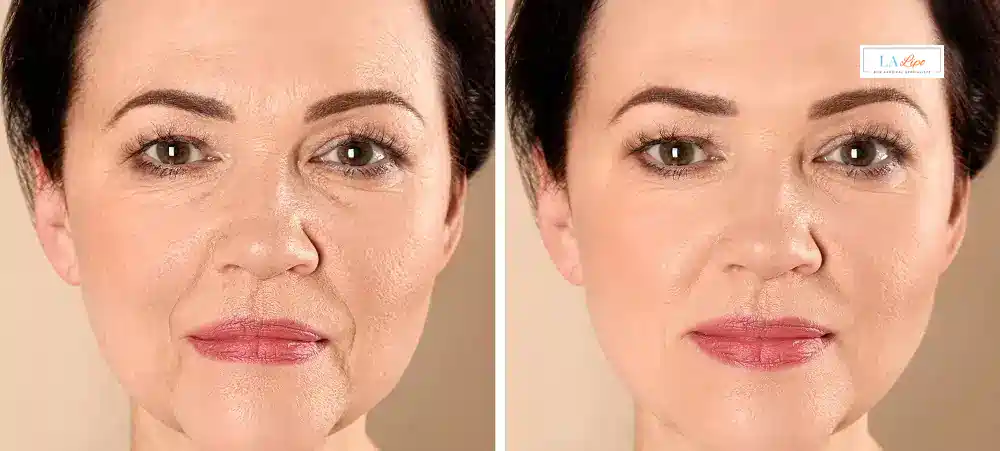 How Long Does It Take to See Results and How Long Do They Last Cumbernauld?